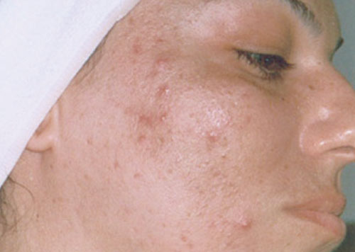 Acne treatment before